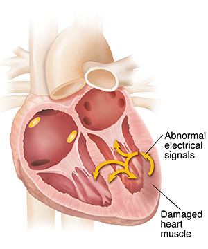 Cross section of heart showing ventricular tachycardia.