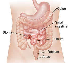 Anterior abdomen showing end ileostomy.