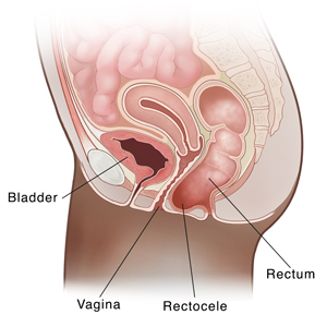 Side view cross section of female pelvis showing rectum sagging into vagina (rectocele).