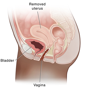 Side view cross section of female pelvis showing a removed uterus.