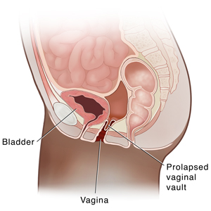 Side view cross section of female pelvis showing prolapsed vaginal vault.