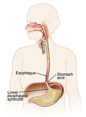 Outline of person showing mouth, esophagus, and stomach. Arrows show stomach acid flowing up esophagus to irritate back of throat.