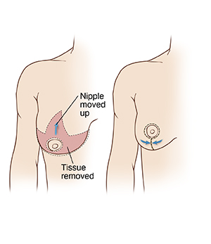 Female chest showing tissue removed in breast reduction surgery. Female chest showing incisions after breast reduction. 