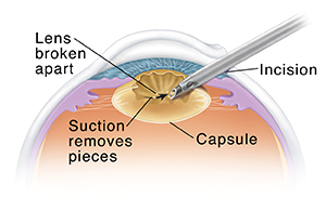 Cross section of eye showing instrument removing lens