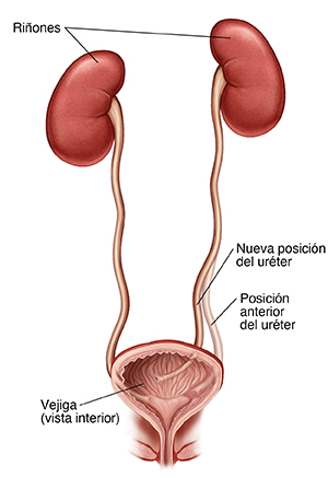 Vista frontal de los riñones, los uréteres y la vejiga. Se ha pasado un uréter a una nueva posición en la vejiga.