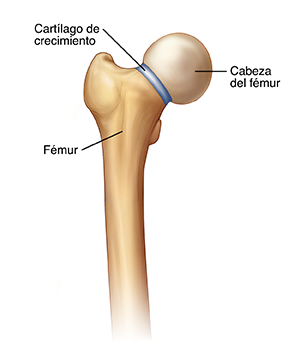 Vista frontal de un fémur en donde se ve la placa de crecimiento entre el cuello y la cabeza del fémur.