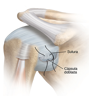 Articulación de hombro que muestra una línea de sutura y la cápsula doblada