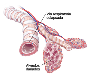 Bronquiolos y alvéolos con enfisema.