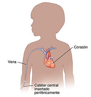 Contorno de un niño con una línea PICC insertada en una vena.