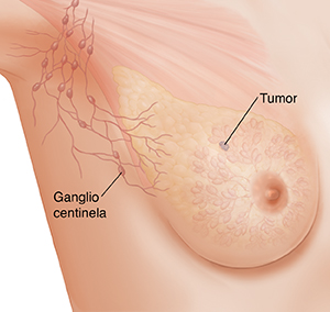 Vista de tres cuartos de la zona de una axila femenina donde puede verse un tumor y el ganglio linfático centinela.